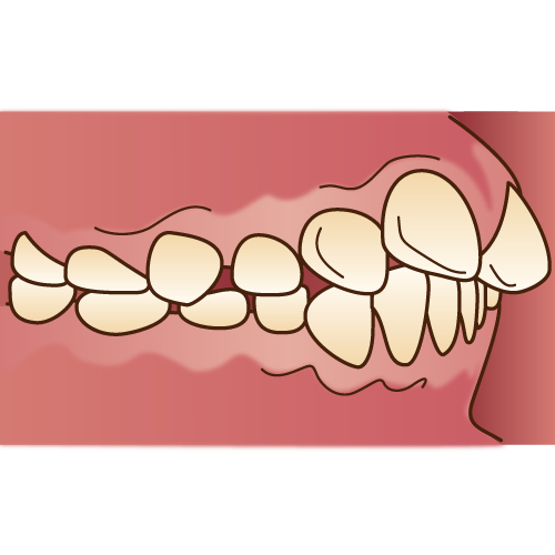 出っ歯（上顎前突）