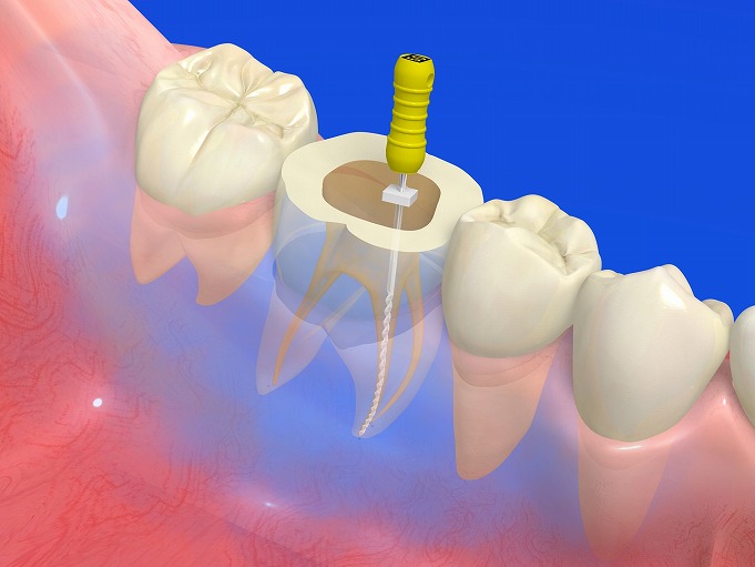 根管治療