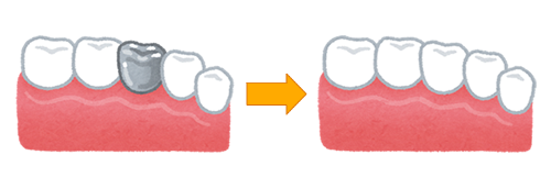 金属アレルギーの方にも対応した詰め物・被せ物